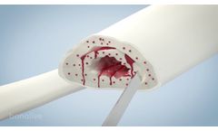 Bonalive granules in septic non-union treatment - Video
