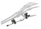 KARPOS - Wrist External Fixator