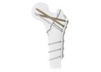Intrauma - Model PFF - Modular Hook for Treating Proximal Femur Fractures
