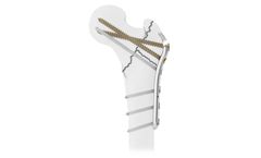 Intrauma - Model PFF - Modular Hook for Treating Proximal Femur Fractures