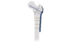 Intrauma - Model PFF Titanium - Proximal Femur With Rail Option