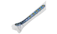 Intrauma - Model Tibia Titanium - Bridge Fixation With Angular Stability Plates
