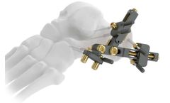 Intrauma - Model TAKO fix - Calcaneal External Fixator