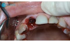 Immediate Loading Implant using adbone TCP - Video