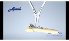Avanti Volar PEEK Plate and Dynamic Device - Video