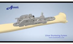 Avanti Ulnar Shortening - Video