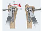 Avanti - Distal Radius Fracture Fixation