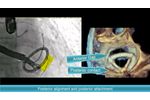 Valcare AMEND Trans-Septal Mitral Repair LMA Procedure Flow - Video