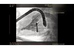 Valcare Helios Mitral Valve Replacement System - Video