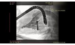 Valcare Helios Mitral Valve Replacement System - Video