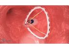 Helios Valcare - Novel Mitral Valve Replacement