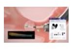 Zephyr Valve Patient Selection - Video