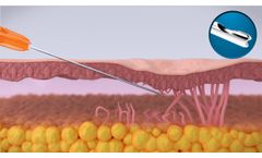 GTI Cannula Animation - How the GTI Cannula Works - Video