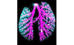 Ventilator-Assisted Aerosol Delivery (VAAD)