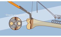 Hinge Plate by Pega Medical - Video