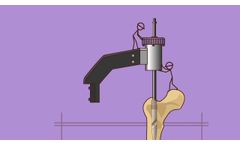 GAP Nail by Pega Medical - Video