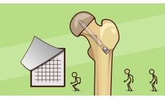 Free-Gliding SCFE Screw by Pega Medical - Video