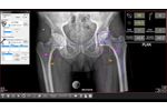 OrthoPlan 2.0 AI-Enabled Pre-Operative Templating Software  - Video