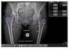 OrthoPlan - Version 2.0 - Dynamic Digital Surgical Planning Software