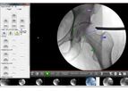 Surgeon Checklist - Version FAI - Minimally-Invasive Solutions for Hip Arthroscopy