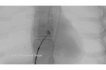 Transseptal Puncture Training Solution -Video