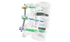 Inertia - Pedicle Screw System
