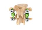 Cousin Surgery - Model BDyn - Posterior Dynamic Stabilization System