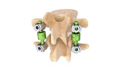 Cousin Surgery - Model BDyn - Posterior Dynamic Stabilization System