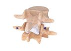 IntraSPINE - Device for the Interspinous Space with Laminar Support