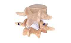 IntraSPINE - Device for the Interspinous Space with Laminar Support