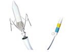 J-Valve - Model TAVI/TAVR - Transapical  System