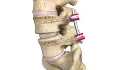 OptiMesh - Expandable Interbody Fusion System