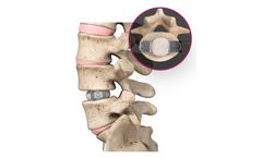 Duo - Model Ti - Expandable Interbody Fusion System