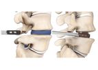 SpineWave Velocity - Expandable Interbody Device