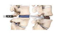 SpineWave Velocity - Expandable Interbody Device