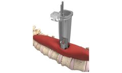 SpineWave - Model CLR - Access System