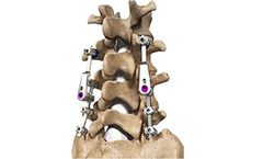 SpineWave Annex - Adjacent Level System