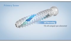 SI-Cure??? Sacroiliac Joint Fusion System - Video
