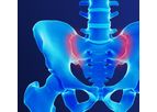 Alevio - Model SI - Diagnosing Sacroiliac Joint Pain