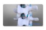 Zenfuze Lumbar Fusion System - Video