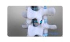 Zenfuze Lumbar Fusion System - Video