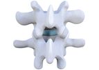 Zenfuze - Lumbar Fusion System