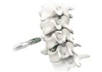 Atlas - Model HiJAK AC - Cervical Spine Spacer System