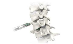 Atlas - Model HiJAK AC - Cervical Spine Spacer System