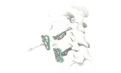 Atlas - Model V3 - Guided Segmental Plating System