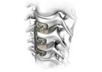 Atlas - Model Verteview - Cervical Plating System