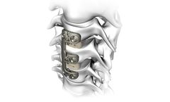 Atlas - Model Verteview - Cervical Plating System