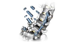 Atlas - Model Apelo - Pedicle Screw System