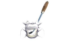 Atlas - Back-Pak Discectomy Set