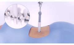 Precision Spine MD-Max Pedicle Screw System - Video